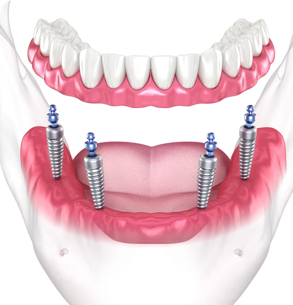All-on-X Denture@1.2x All on X Denture@1.2x