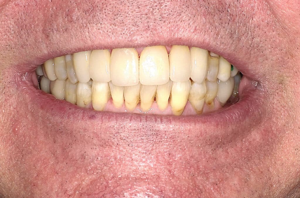 After Image: Anterior Crown - front