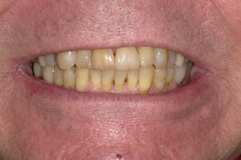 Before Image: Anterior Crown - front