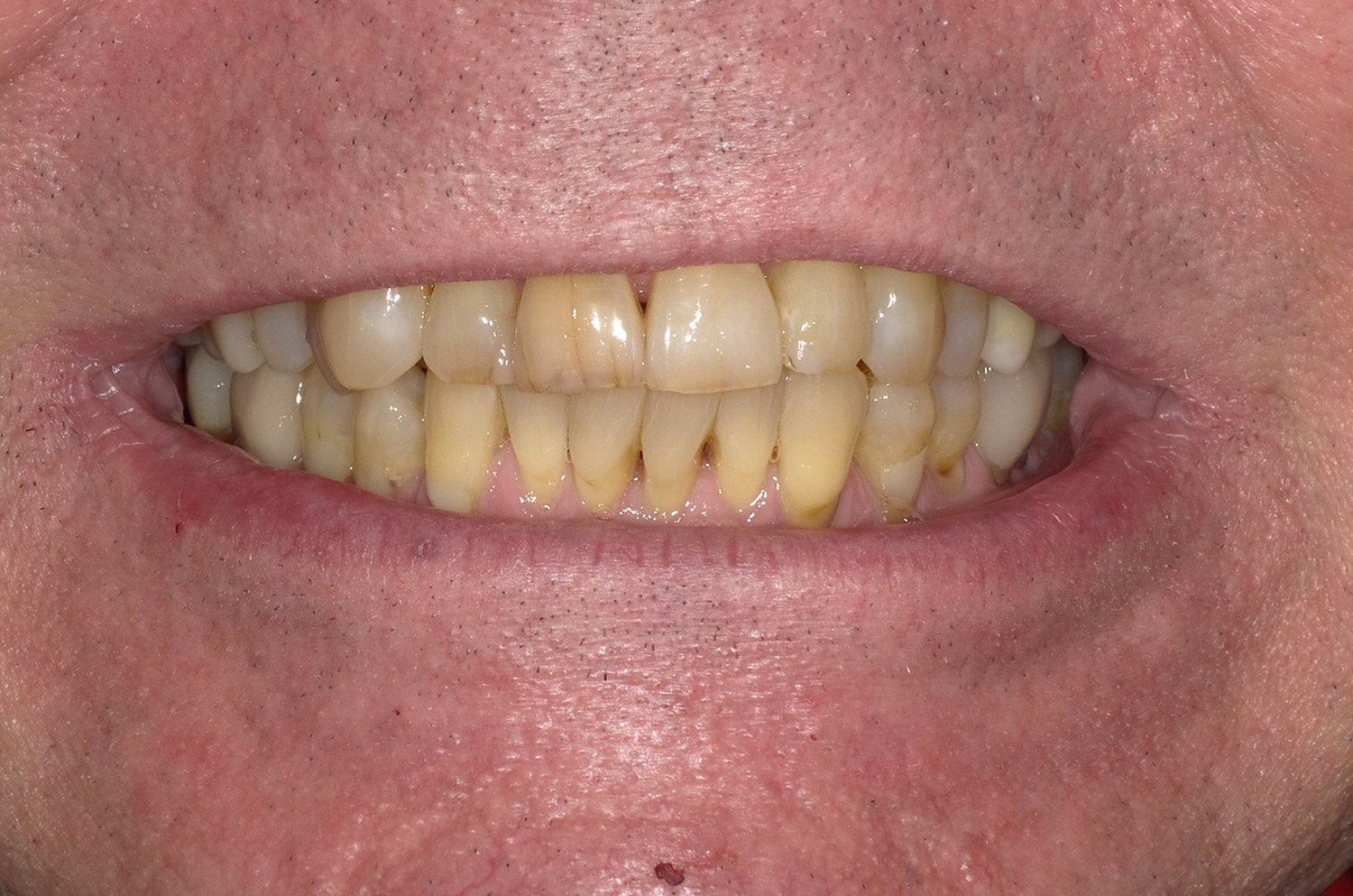 Before Image: Anterior Crown - front