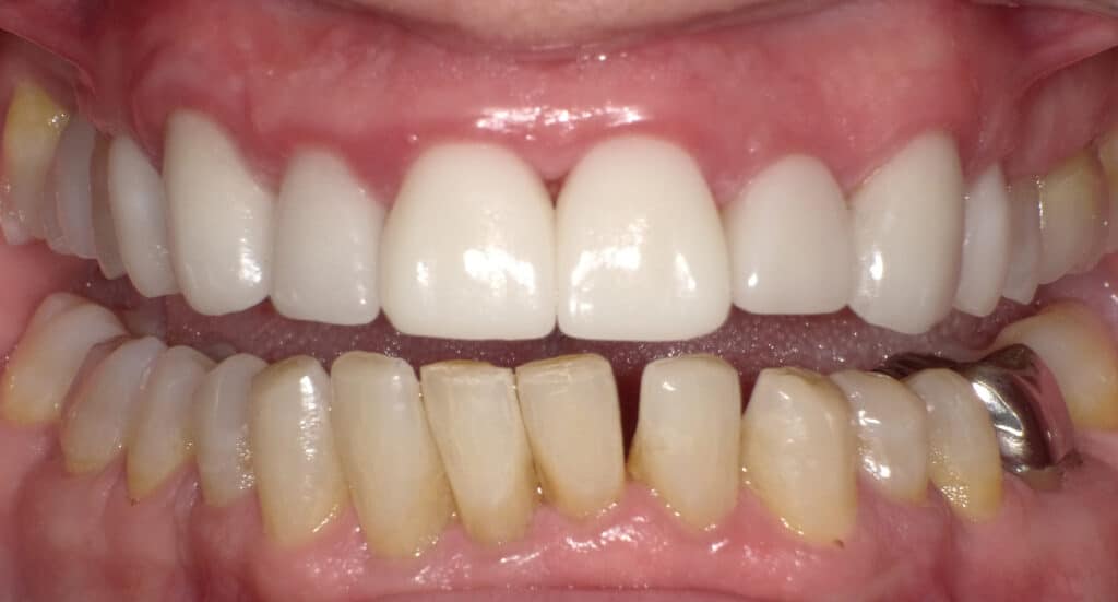 After Image: Anterior Crown - front
