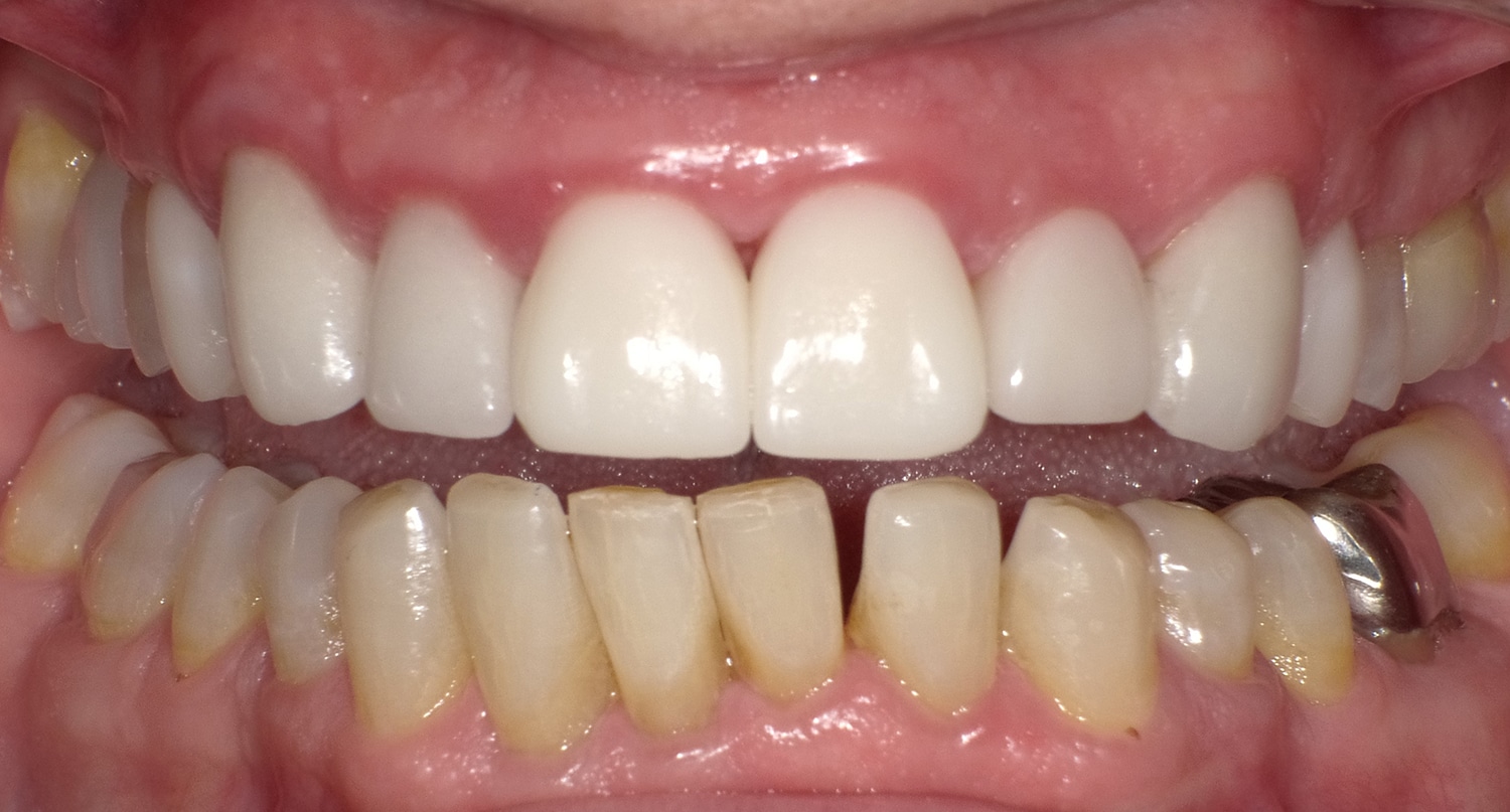 After Image: Anterior Crown - front