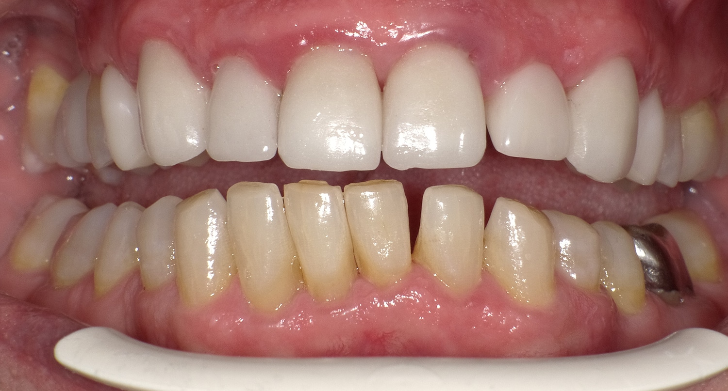 Before Image: Anterior Crown - front