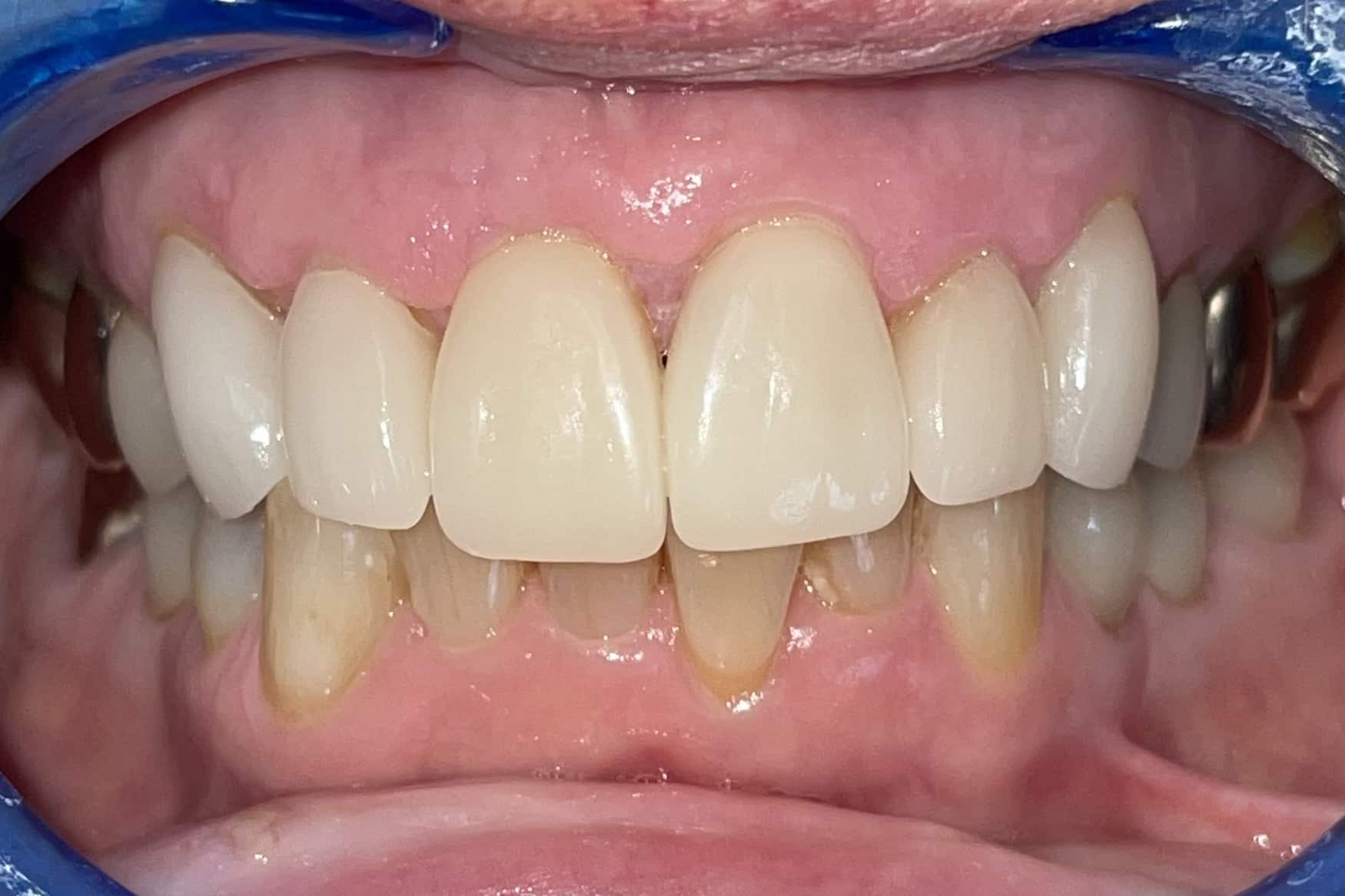 After Image: Anterior Crown - front