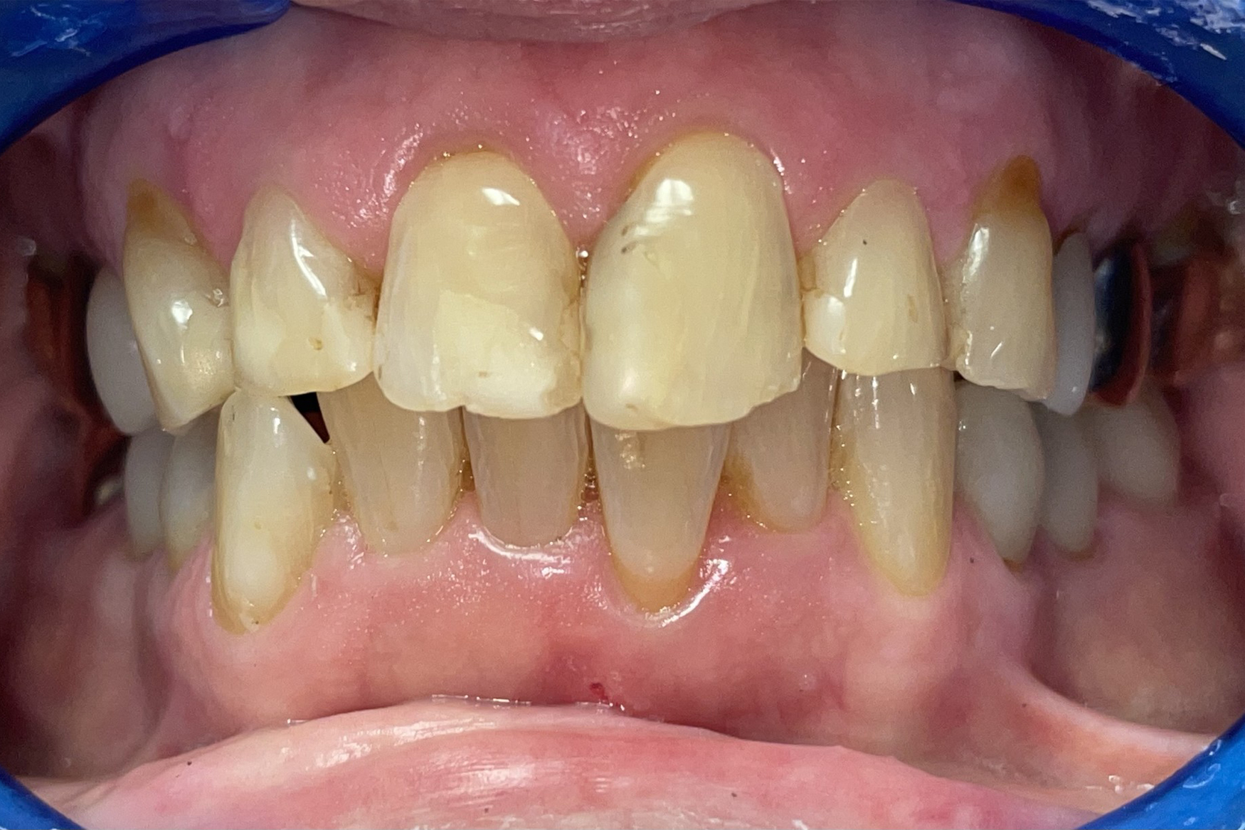 Before Image: Anterior Crown - front
