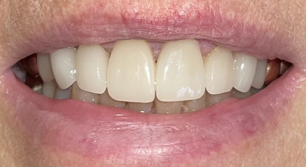 After Image: Anterior Crown - front
