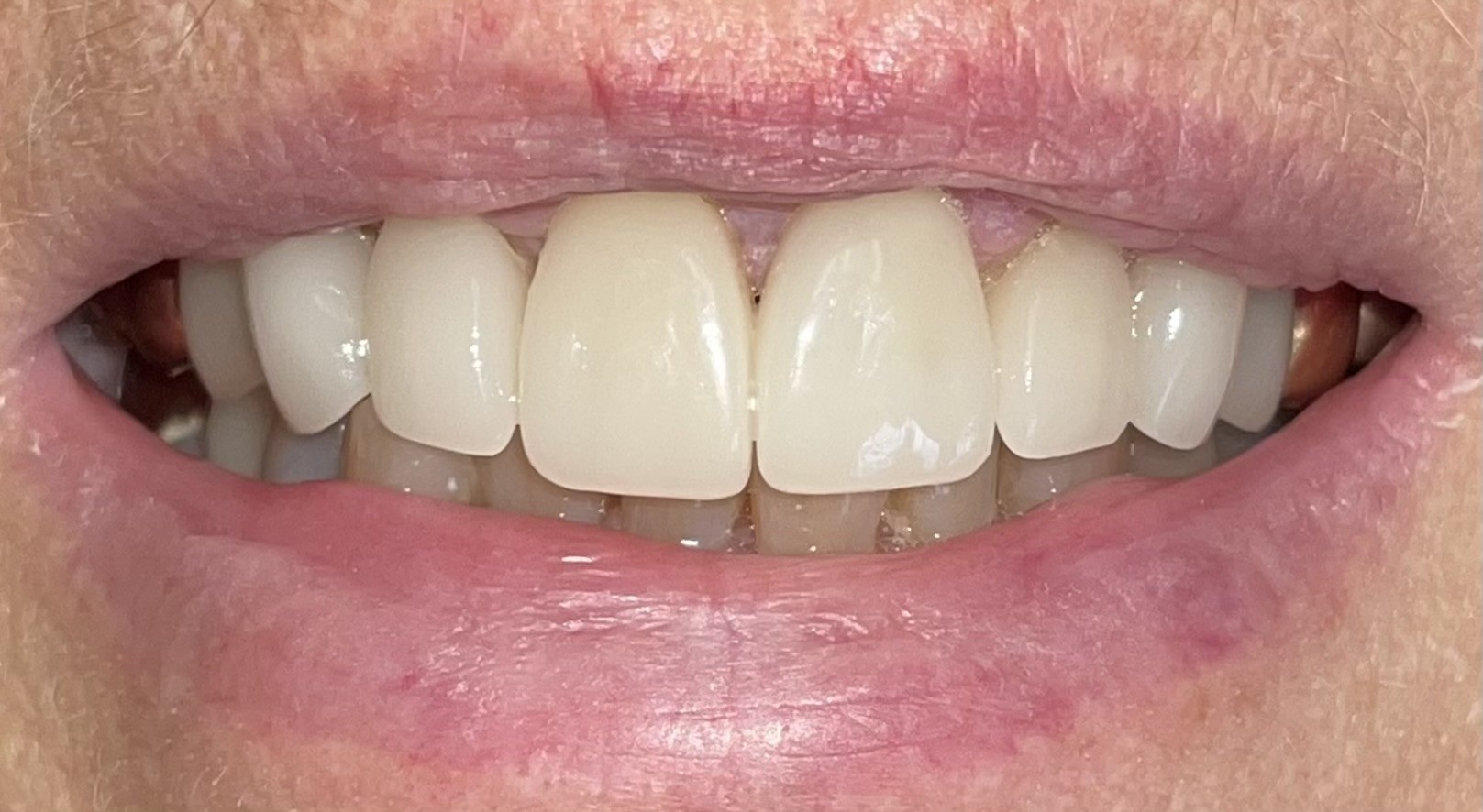 After Image: Anterior Crown - front