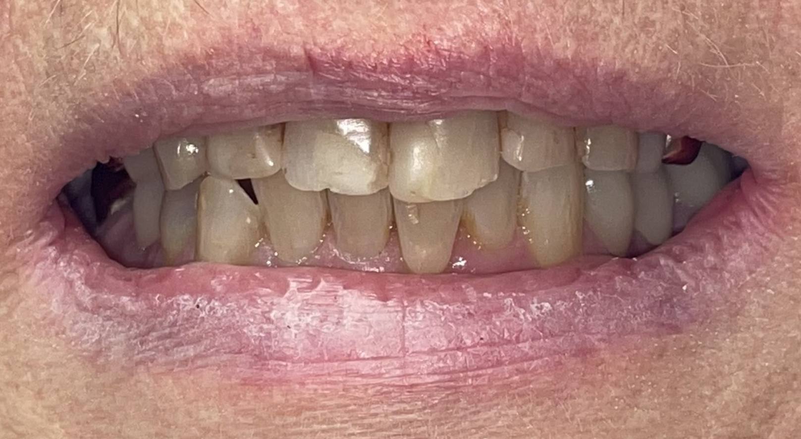 Before Image: Anterior Crown - front