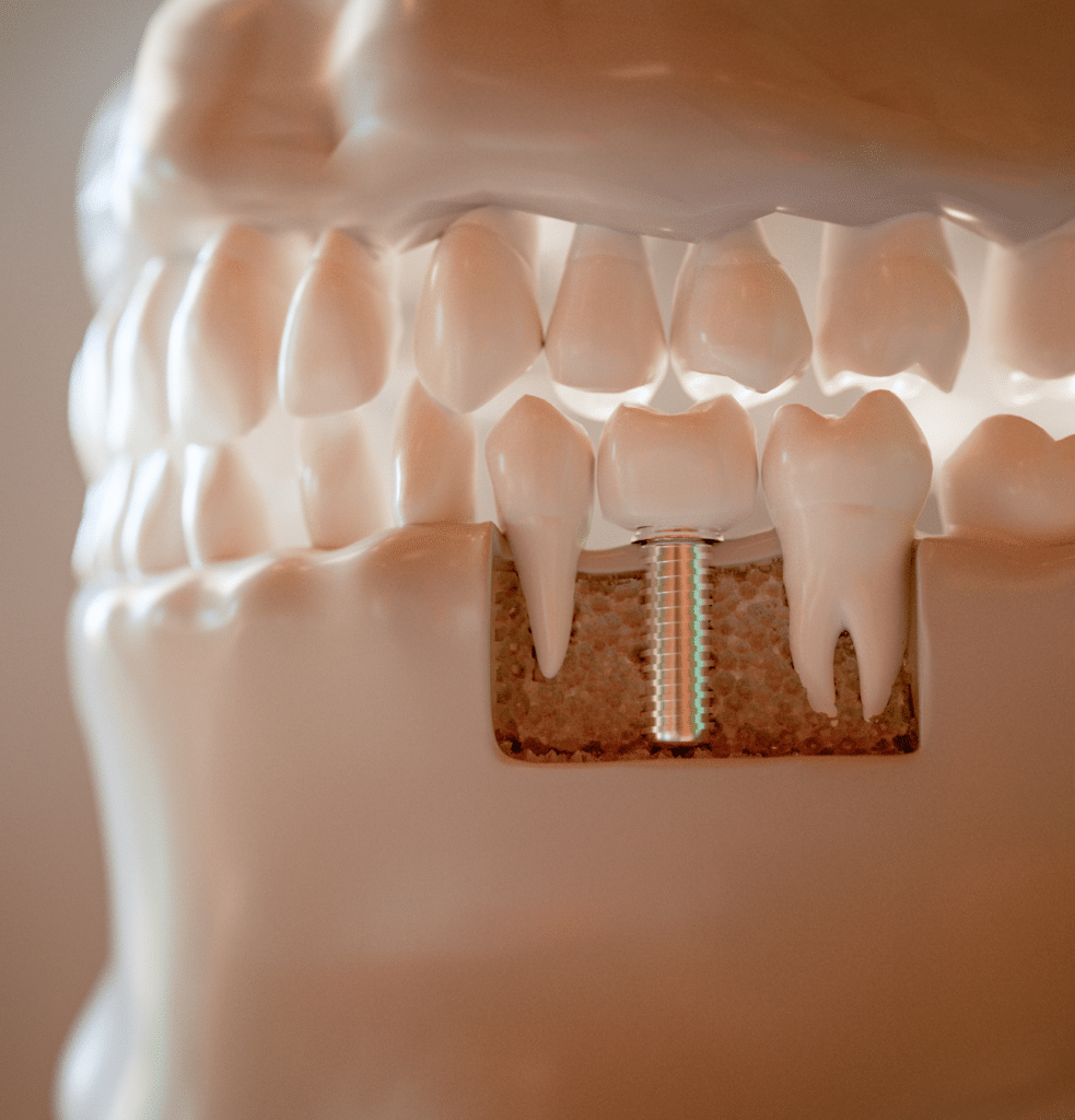 Dental Implants@1.2x Dental Implants@1.2x