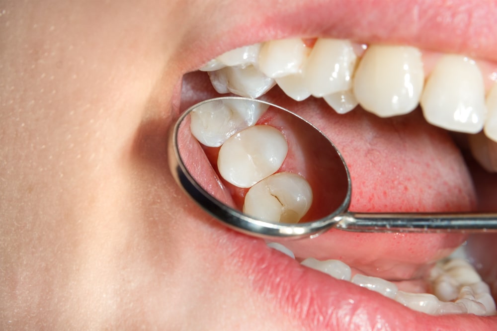 Close-up of a patient's mouth reflected after getting dental filling treatment to repair cavities.